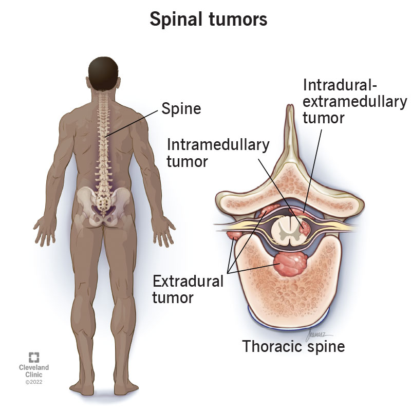17500-spinal-tumors